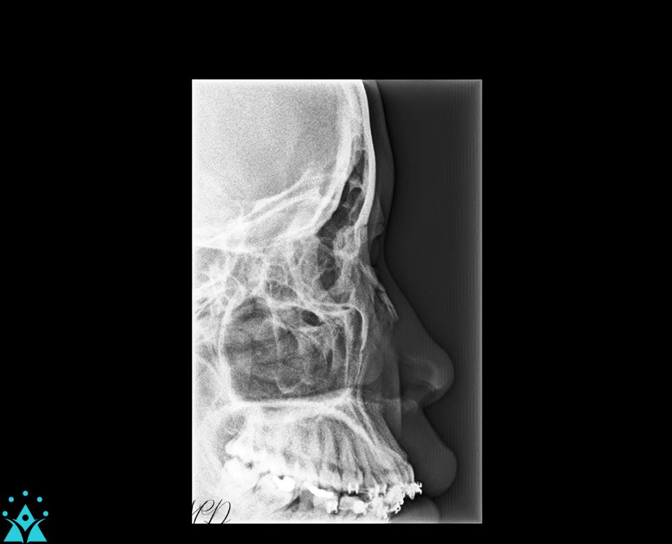 Lateral Nasal Bone X Ray Showing Closed Fracture Of Nasal Bone Or