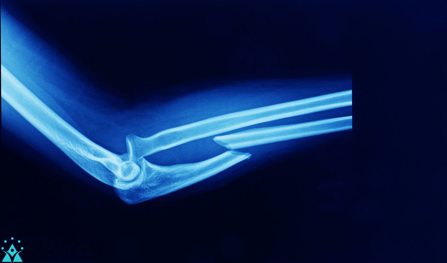 lateral xray of elbow showing fracture of proximal ulnar shaft and
