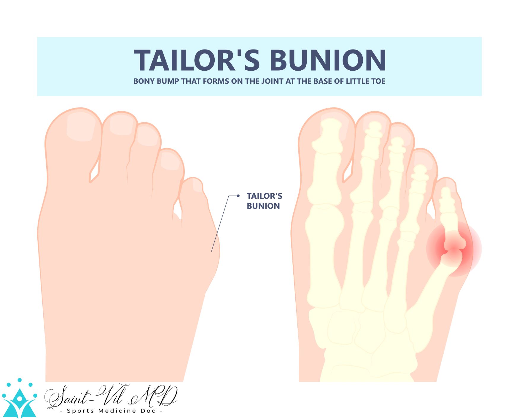 bony bump joint big toe bone enlarge fifth foot pain shoe Tailor