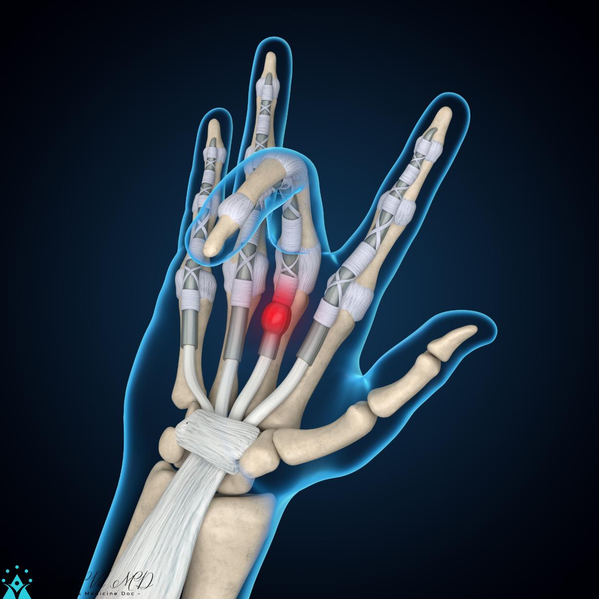Trigger Finger 3D Rendering, Finger Anatomy, Hand Anatomy ExerciseNow