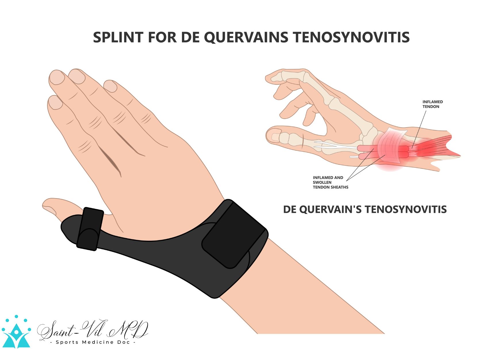 De quervain's pain tendon thumb wrist hurt grasp make a fist sport