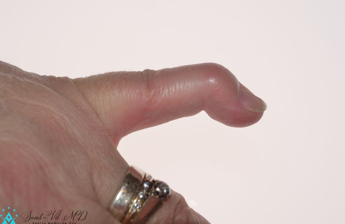 A mallet finger a deformity of the little finger caused when the tendon