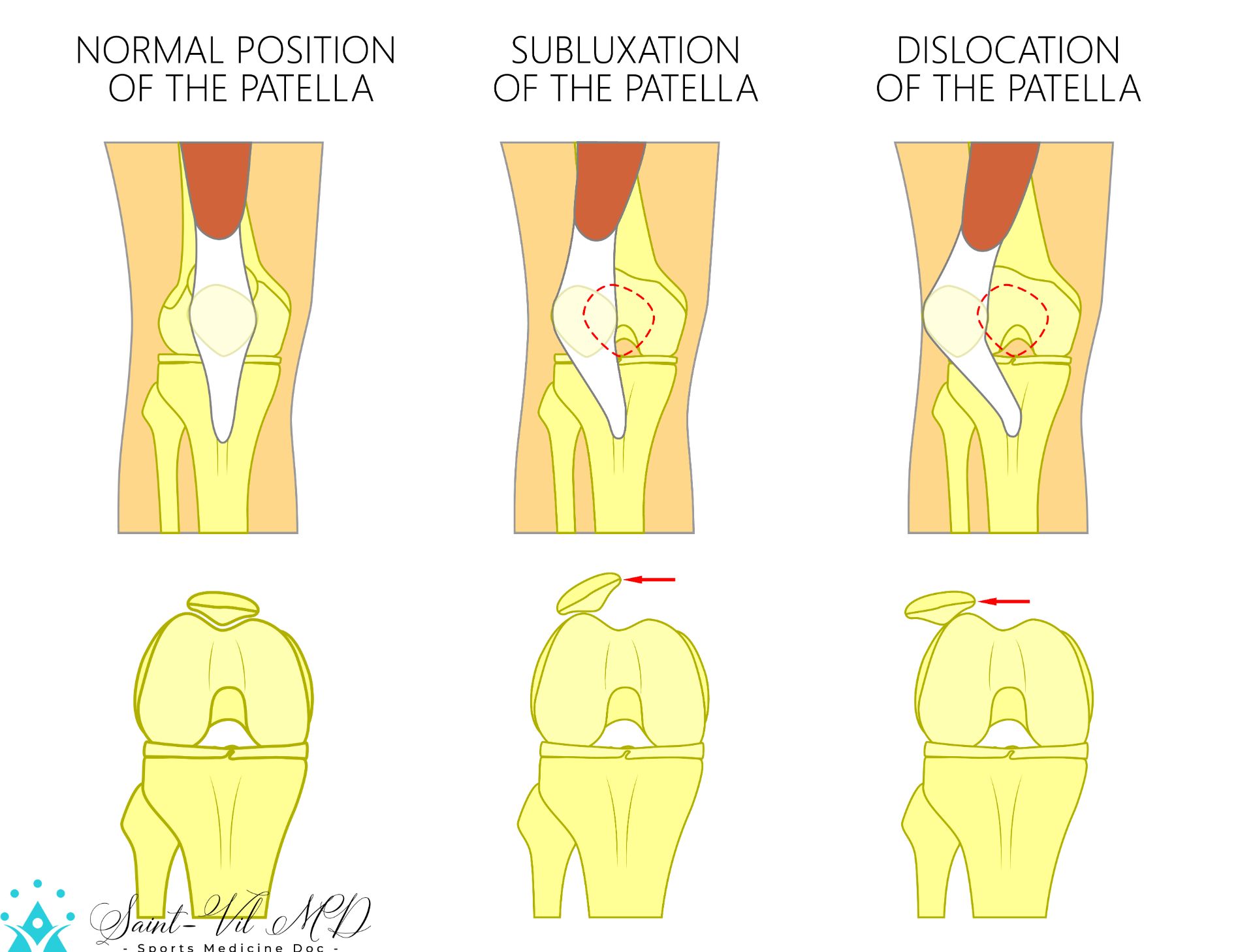 Vector illustration of a healthy human knee joint and unhealthy knees with problem. Subluxation