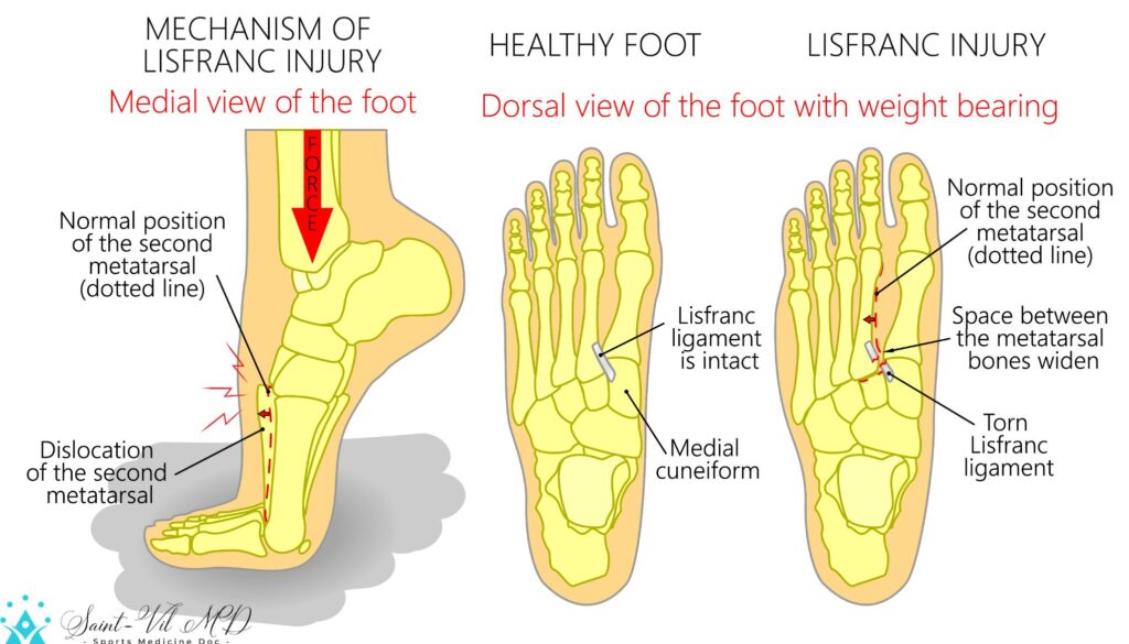 Vector illustration of a healthy human foot and a foot with lisfranc